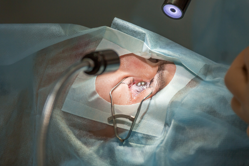 Private Krankenversicherung - : Kostenerstattung für refraktiven laser-chirurgischen Eingriff