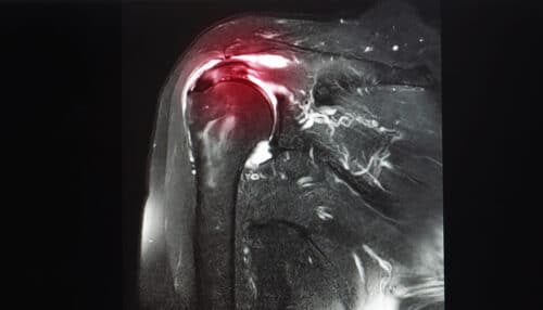 Rupture of the supraspinatus tendon