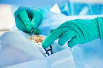 Katarakt-Operation – Verwendung eines Femtosekundenlasers